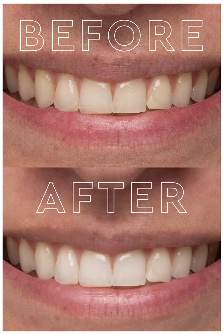 The Teeth Whitening Device System, Alternate, color, NO COLOR
