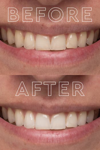 The Teeth Whitening Device System
