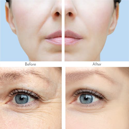 Truly Clear Wrinkle Patches 4 Patches With Hyaluronic Acid,peptides & Collagen In Multi
