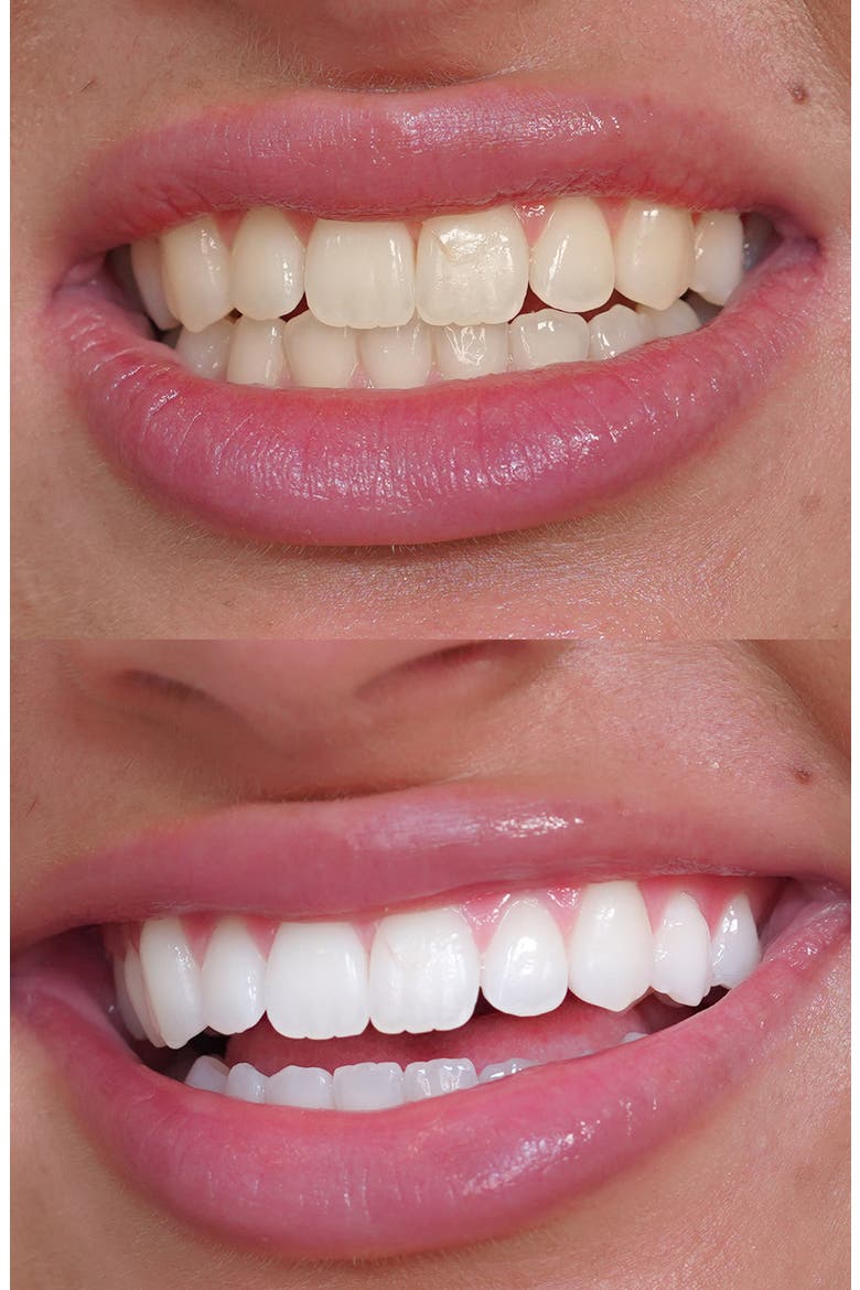 Diamond Wireless Teeth Whitening Kit (Limited Edition) $299 Value, Alternate, color, RED