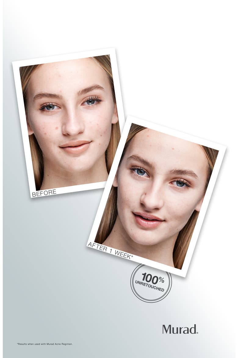 Outsmart Acne Clarifying Treatment, Alternate, color, NO COLOR