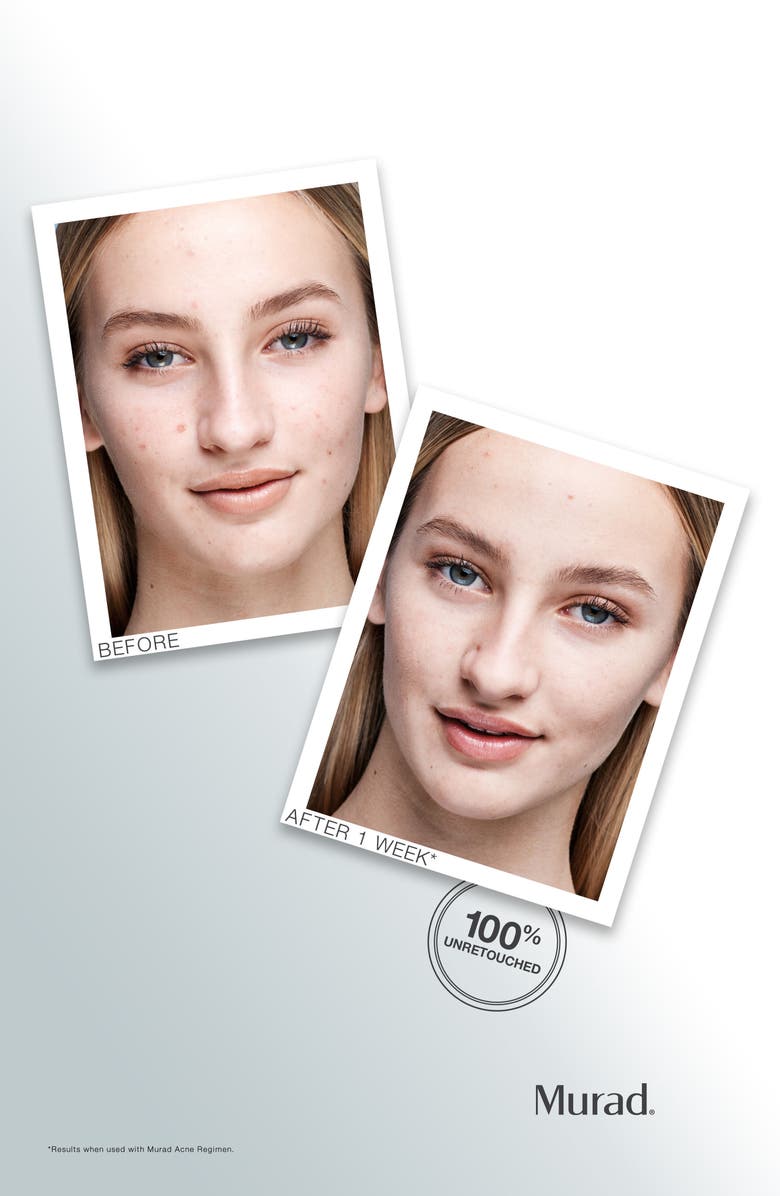 Murad<sup>®</sup> Outsmart Acne Clarifying Treatment, Alternate, color, 