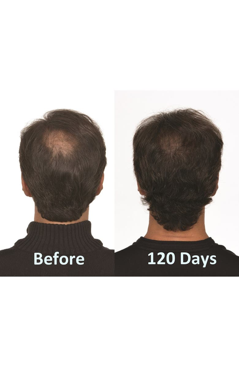 IGROW <sup>®</sup> Laser Hair Rejuvenation System, Alternate, color, 