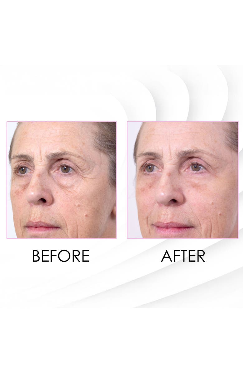 SKINCHEMISTS Wrinkle Killer Instant Face Lift 5 x 2ml x 2 Duo Set, Alternate, color, White