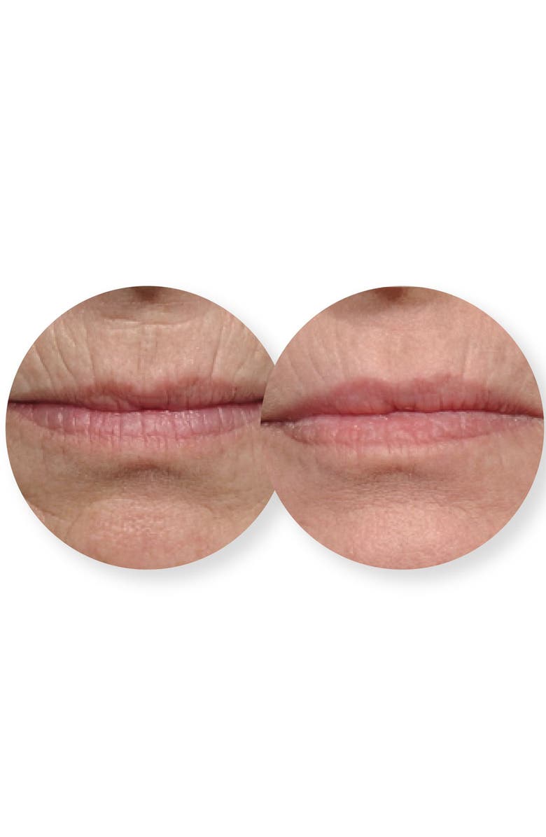 Dermovia Lace Your Face Rejuvenating Collagen Compression Facial Mask, Alternate, color, 