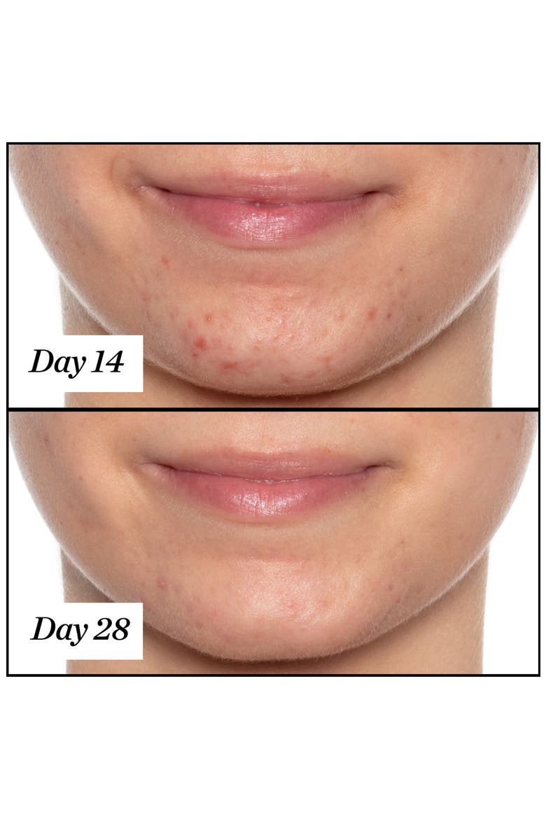 U.F.O. Ultra-Clarifying Acne Treatment Face Oil, Alternate, color, NO COLOR