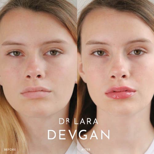 Dr. Devgan Scientific Beauty Vermillion Lip Plump In Transparent