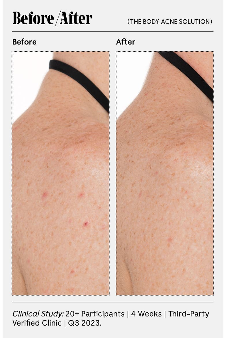 The Body Acne Solution, Alternate, color, NO COLOR