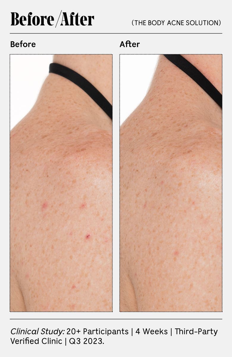 Nécessaire The Body Acne Solution, Alternate, color,