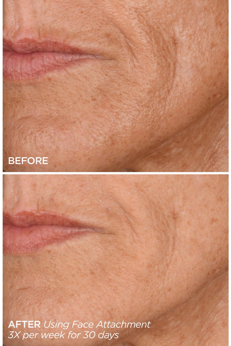 Get That Glow GloPRO® Facial Microneedling Discovery Set $233 Value, Alternate, color, NO COLOR