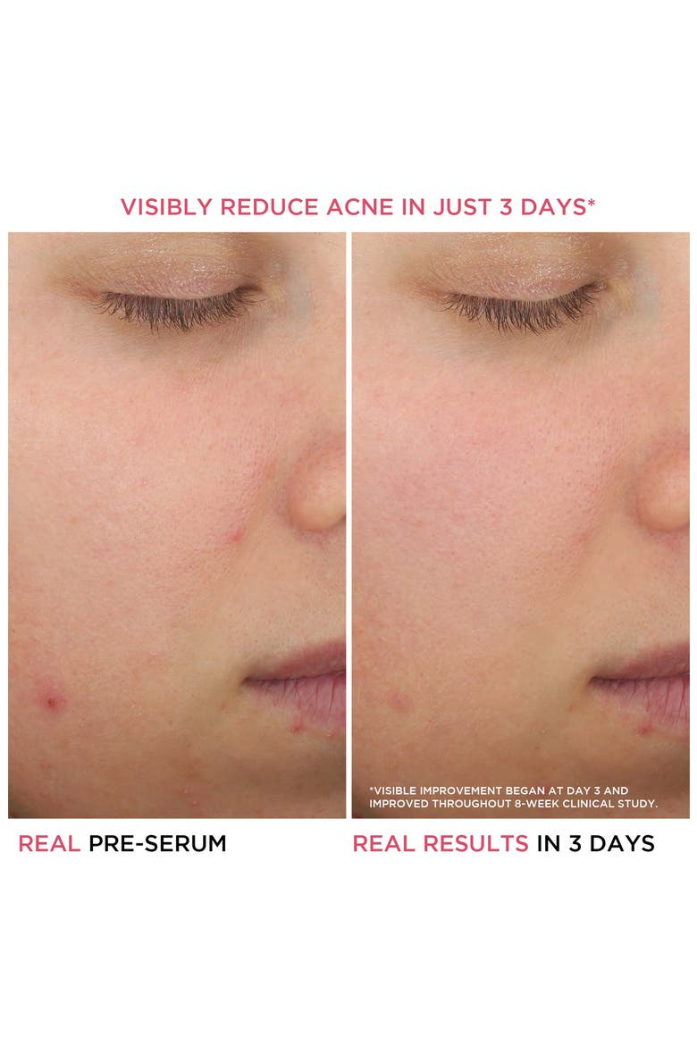 Bye Bye Breakout Salicylic Acid Acne Serum, Alternate, color, NO COLOR