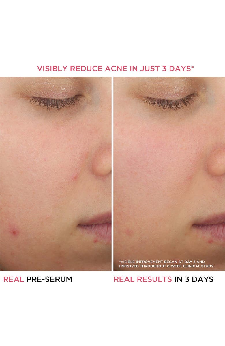 IT Cosmetics Bye Bye Breakout Salicylic Acid Acne Serum, Alternate, color,