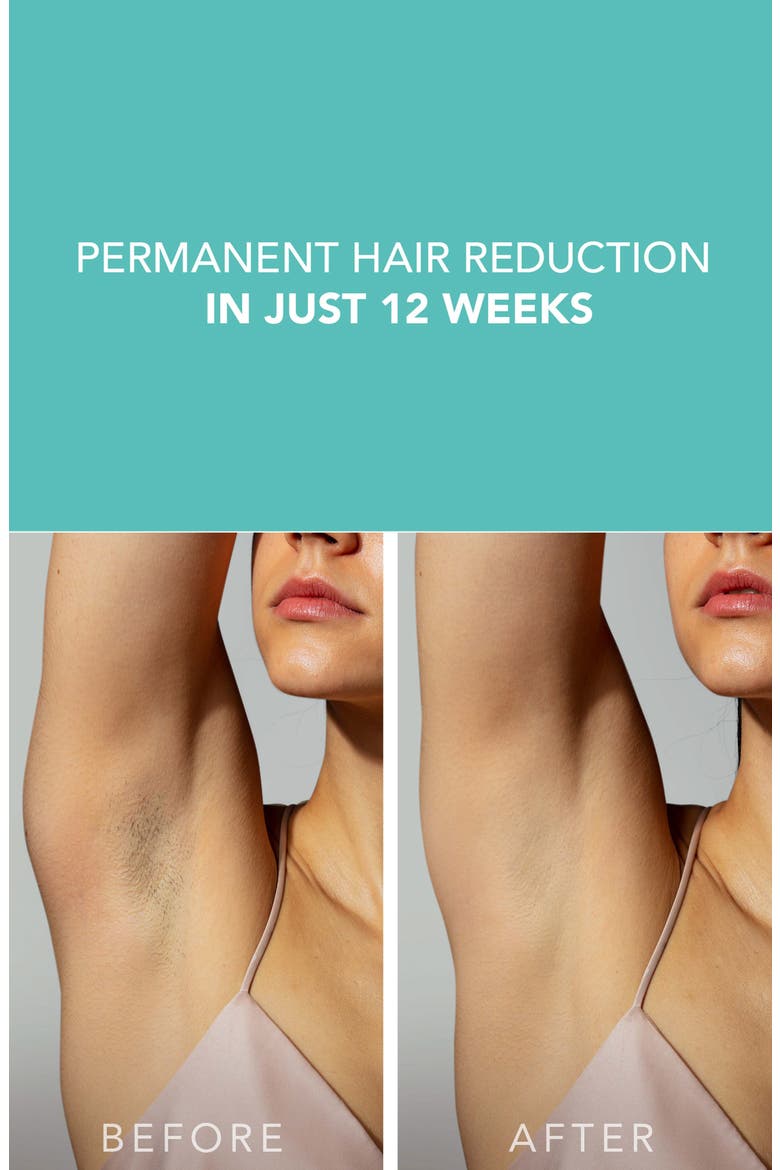 PEACH™ 2 IPL Hair Removal Device & Prep Gel Bundle, Alternate, color, GREEN