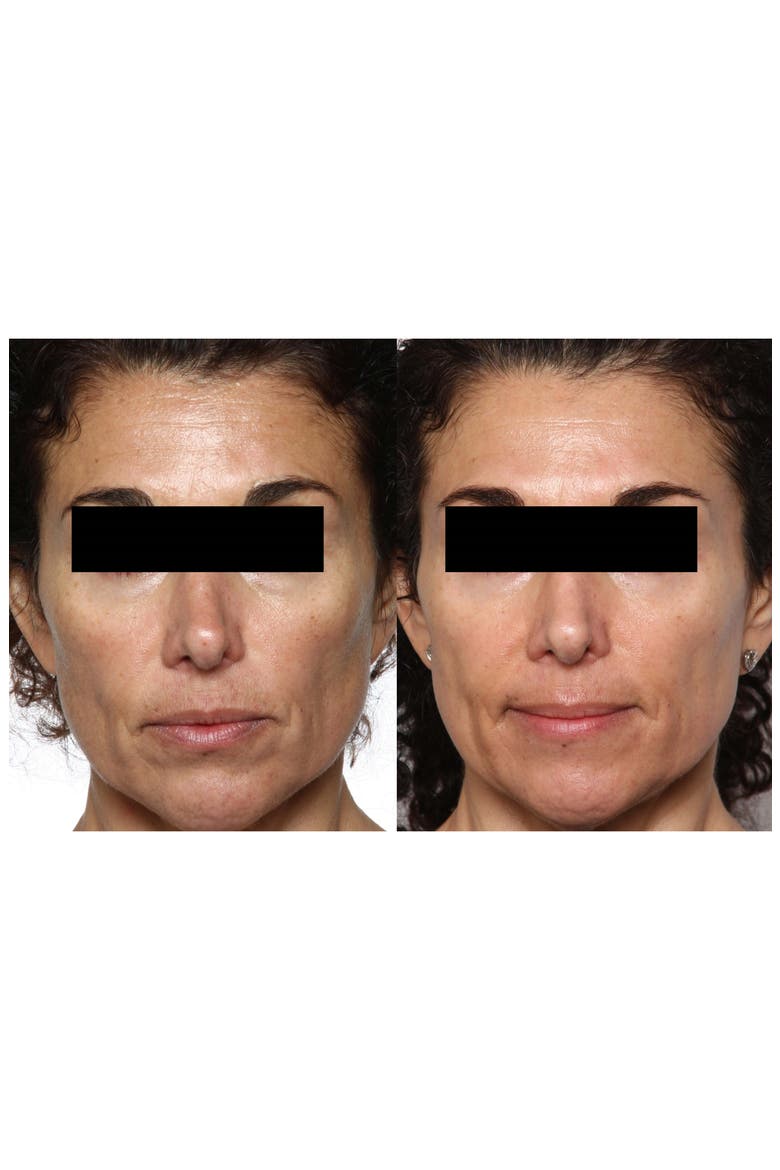 FaceFX™ Anti-Aging Device, Alternate, color, NO COLOR