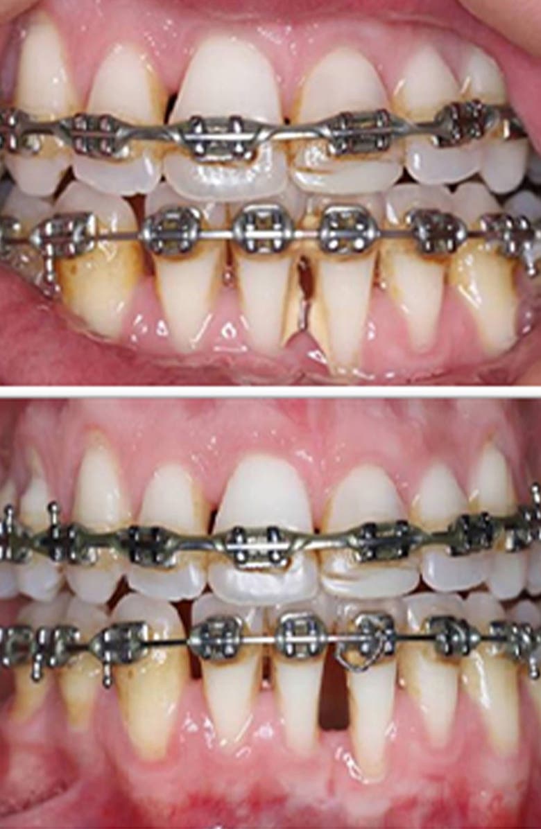 Silk'n Toothwave Dental Toothbrush, Alternate, color,