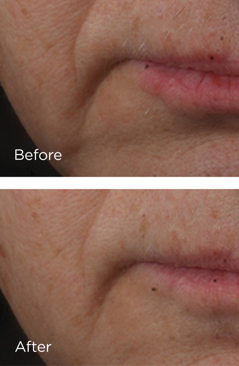 Perricone MD Cold Plasma+ Advanced Serum Concentrate, Alternate, color, 