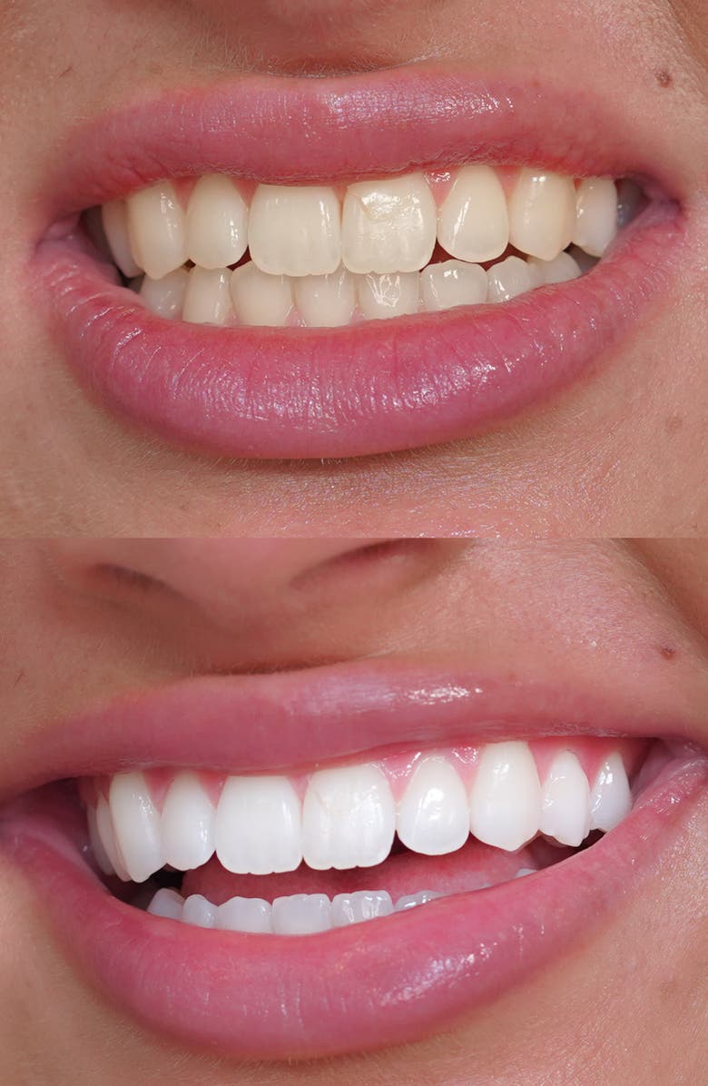 SNOW Diamond Teeth Whitening Kit, Alternate, color,