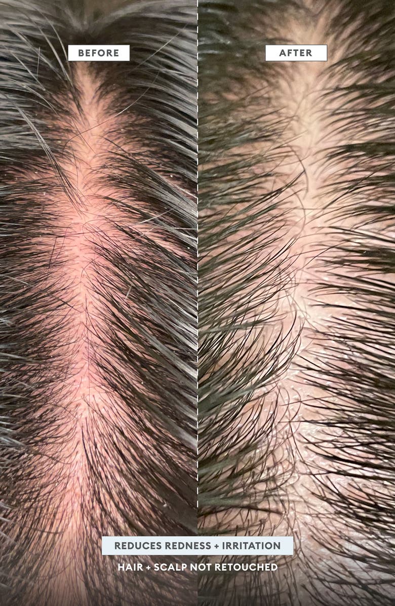Scalp Revival<sup>™</sup> MegaStrength+ Dandruff Relief Shampoo Charcoal + AHA/BHA with Salicyic Acid 3%