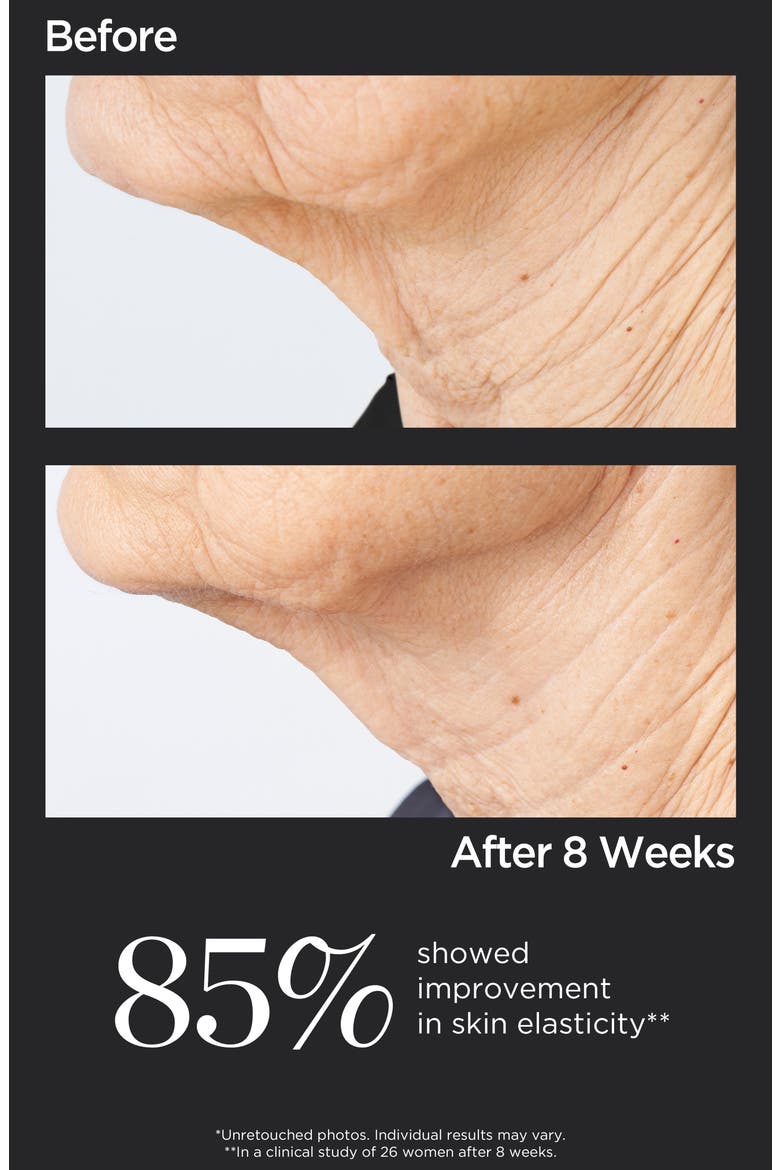 Cold Plasma+ Sub-D Neck Treatment, Alternate, color, NO COLOR