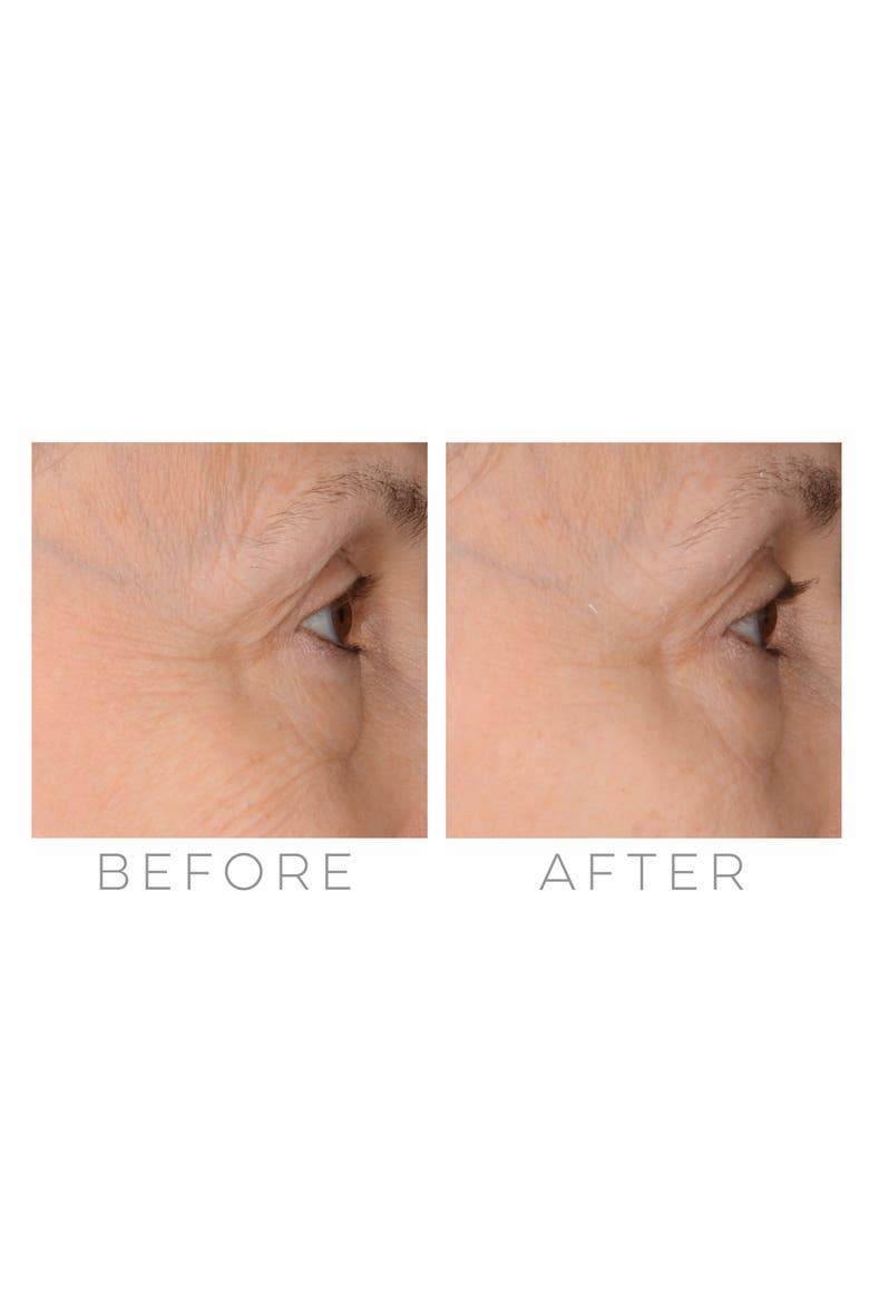 GloPRO® Microneedling Regeneration Tool with FACE & BODY MicroTip™ Attachments, Alternate, color, NO COLOR