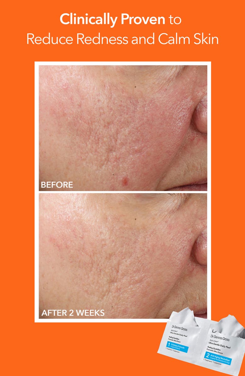 Dr. Dennis Gross Skincare Alpha Beta<sup>®</sup> Ultra Gentle Daily Peel - 30 Applications, Alternate, color, 