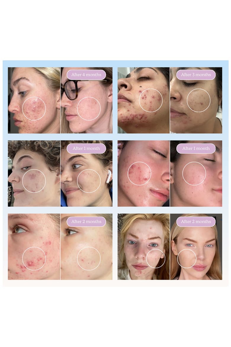 Meltdown Blemish Treatment, Alternate, color, BABY BLUE