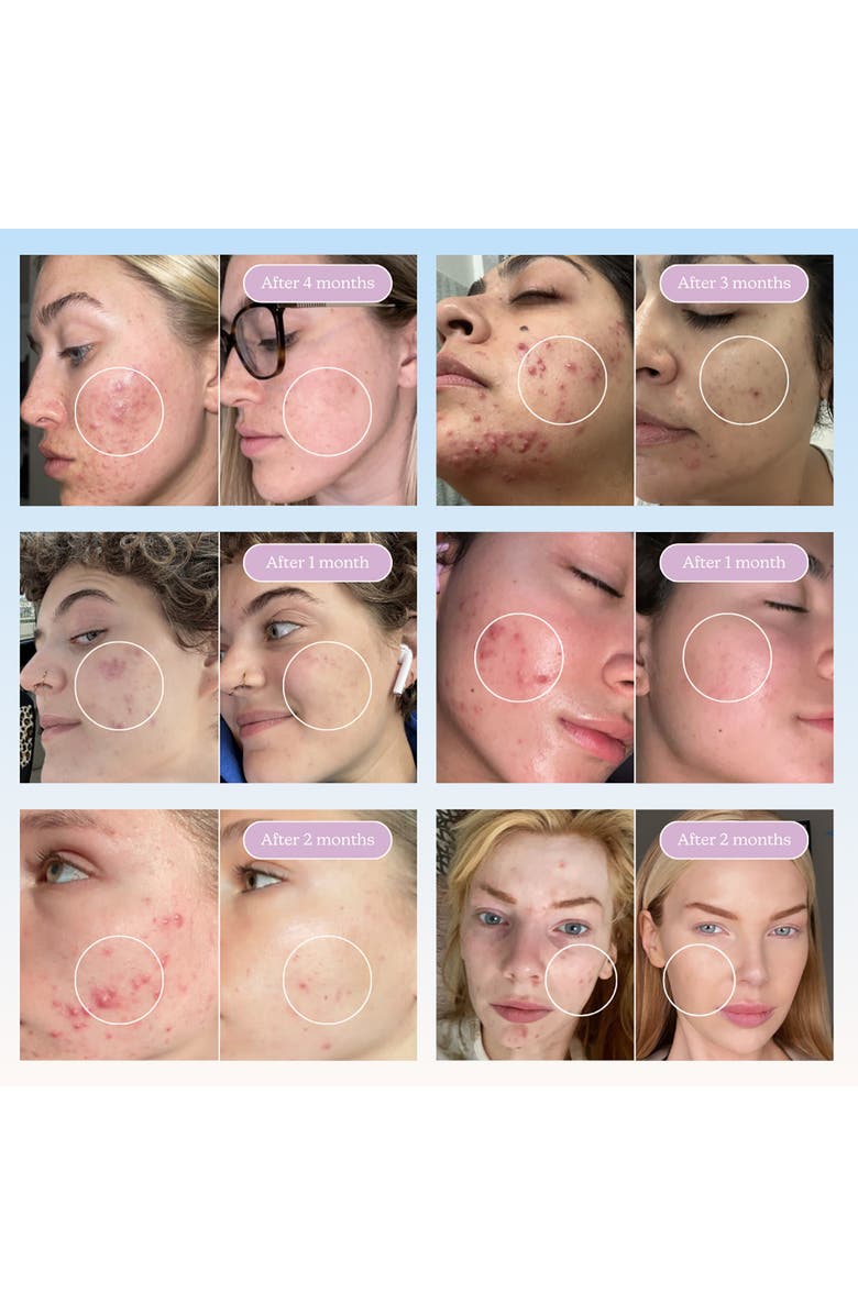 BLUME Meltdown Blemish Treatment, Alternate, color, Baby Blue