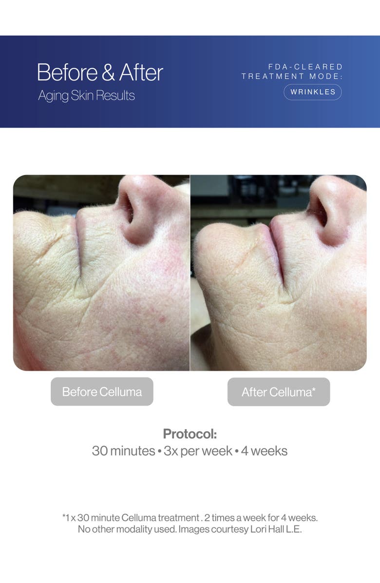 Celluma Nova LED Light Therapy, Alternate, color, Blue