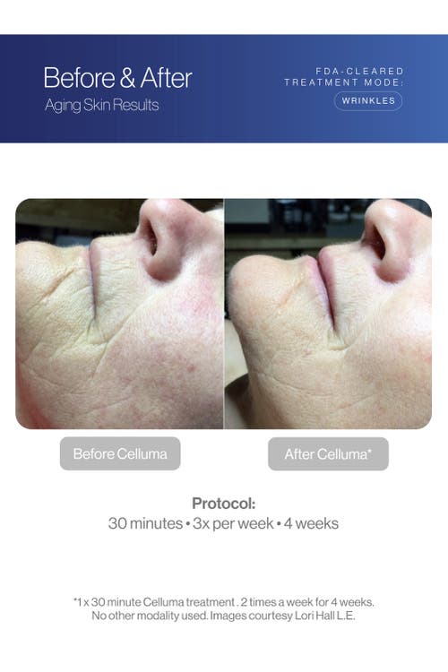 Celluma Nova Led Light Therapy In Blue