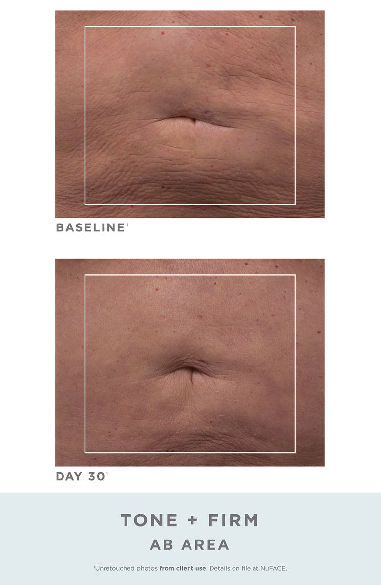 NuFACE<sup>®</sup> NuBODY Skin Toning Device Challenge Set, Alternate, color,