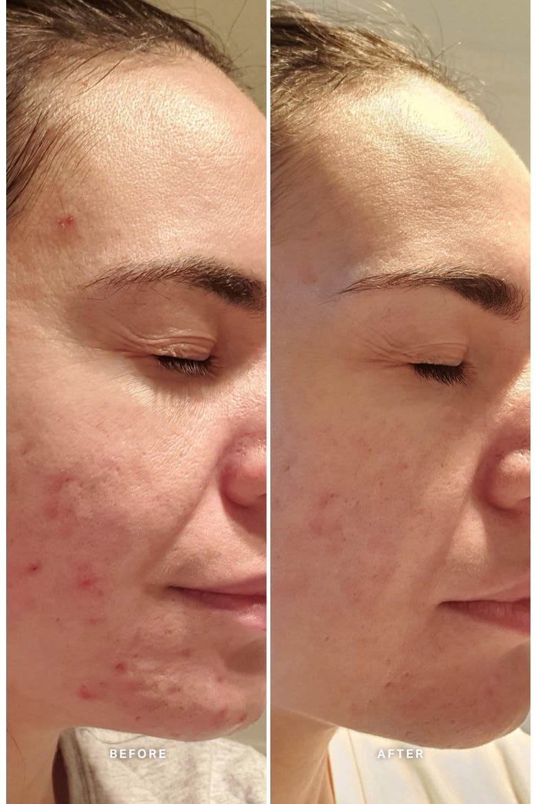 Liquid Gold™ Exfoliating Treatment with Glycolic Acid, Alternate, color, NO COLOR
