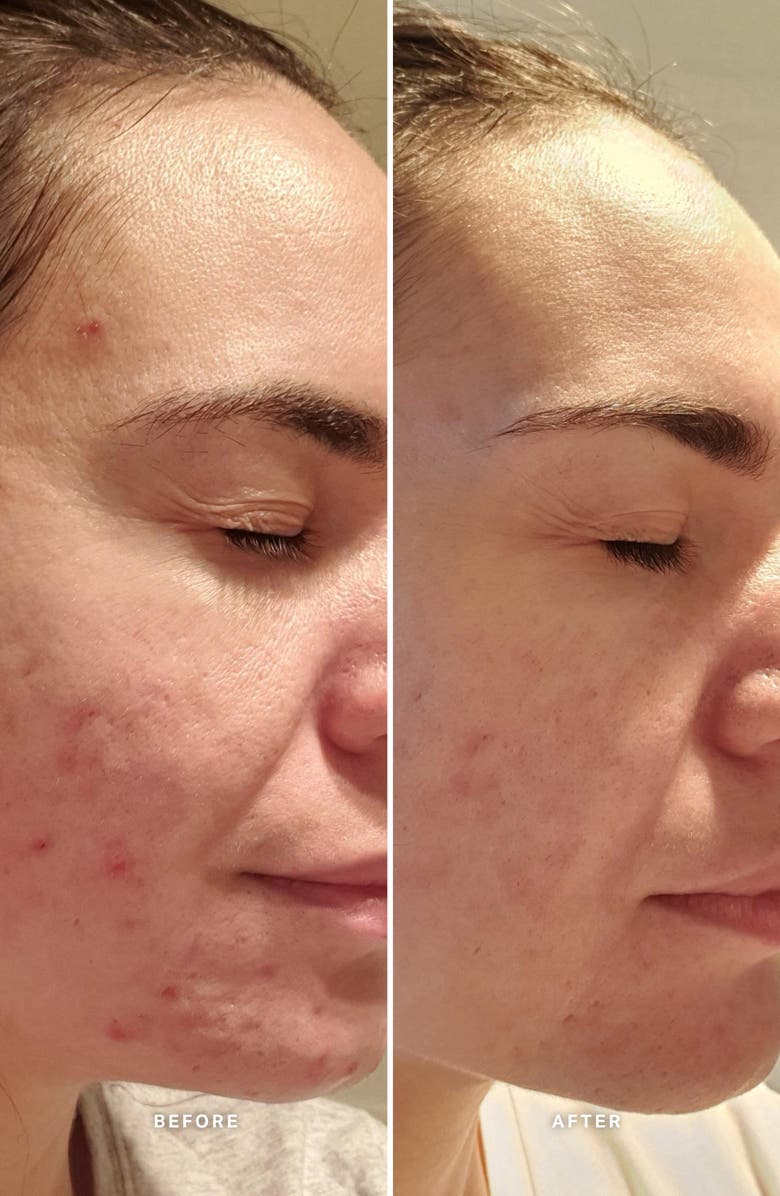 Alpha-H Liquid Gold<sup>™</sup> Exfoliating Treatment with Glycolic Acid, Alternate, color, 