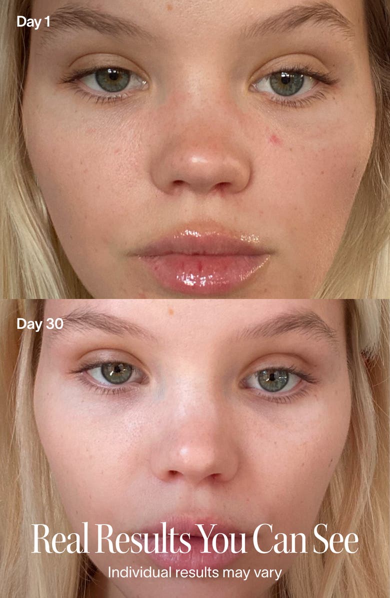 SolaWave 3 Minute Light Therapy Acne Spot Treatment, Alternate, color, Periwinkle