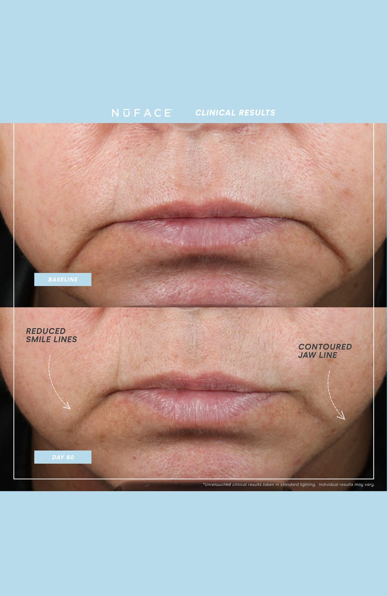 NuFACE<sup>®</sup> MINI+<sup>®</sup> Starter Kit $250 Value, Alternate, color,