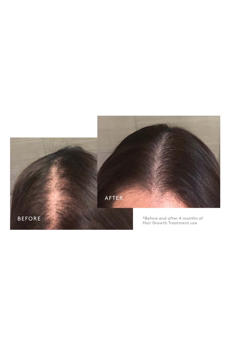 Flourish® Hair Growth Treatment for Moderate to Severe Hair Loss, Alternate, color, 90 DAY