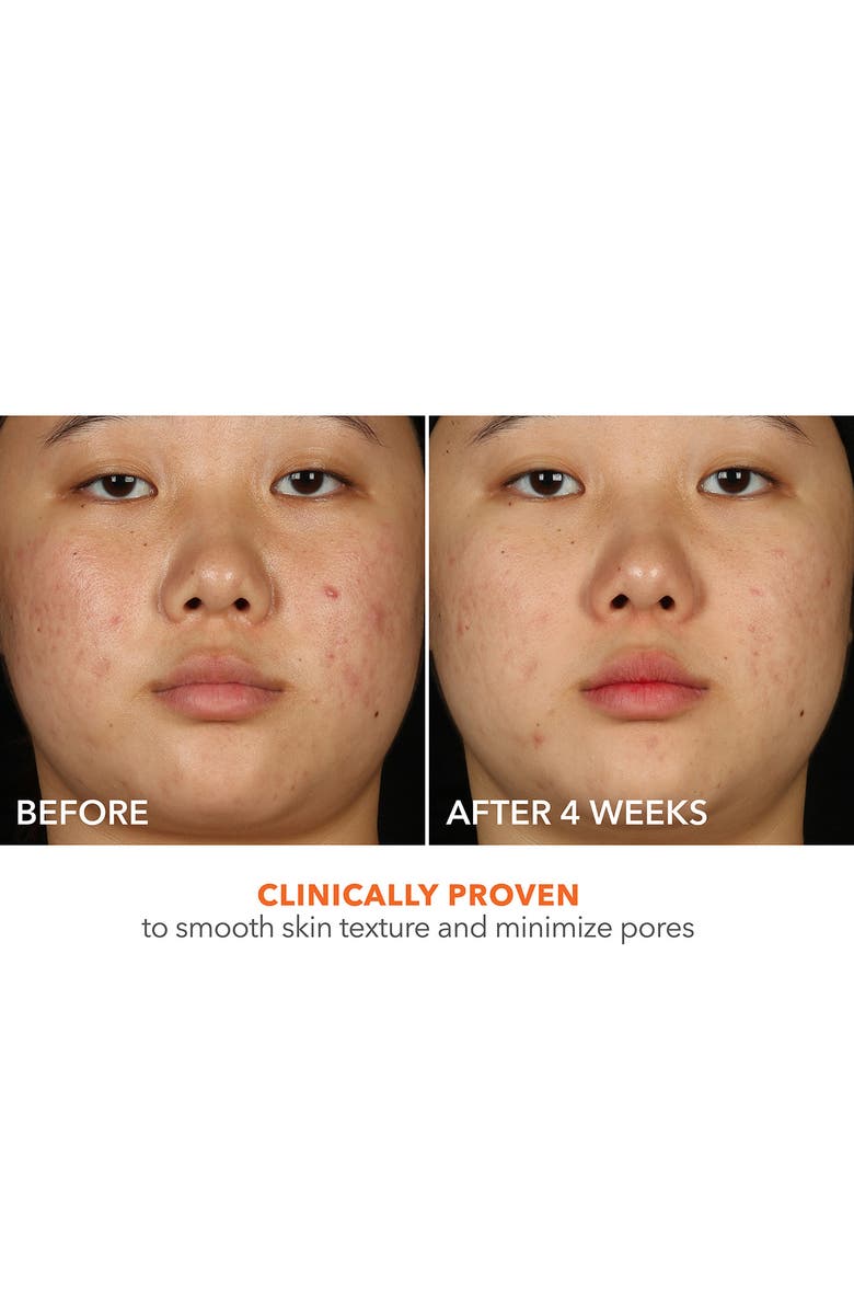 Dr. Dennis Gross Skincare Alpha Beta<sup>®</sup> 2% BHA+ Breakout Solution, Alternate, color, 