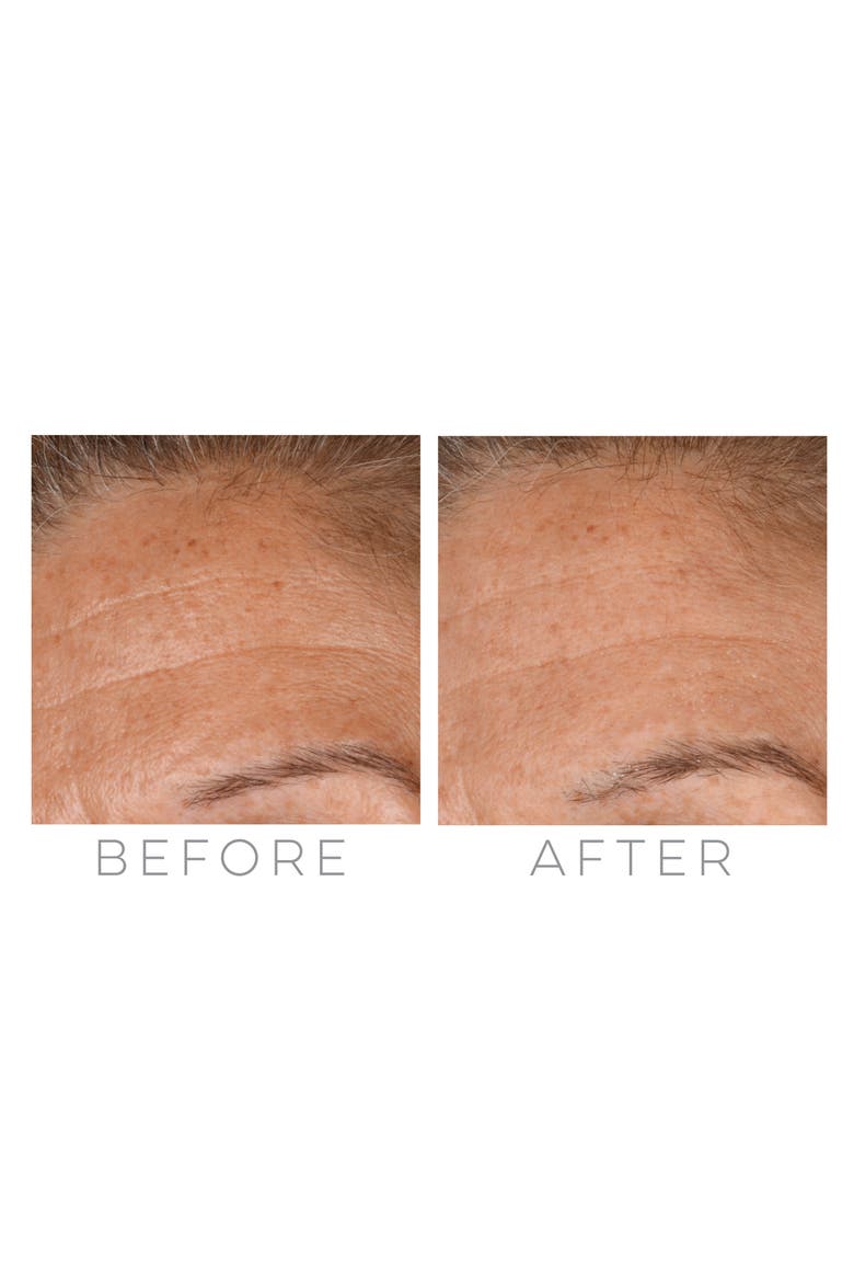 GloPRO® Microneedling Regeneration Tool with FACE & BODY MicroTip™ Attachments, Alternate, color, NO COLOR