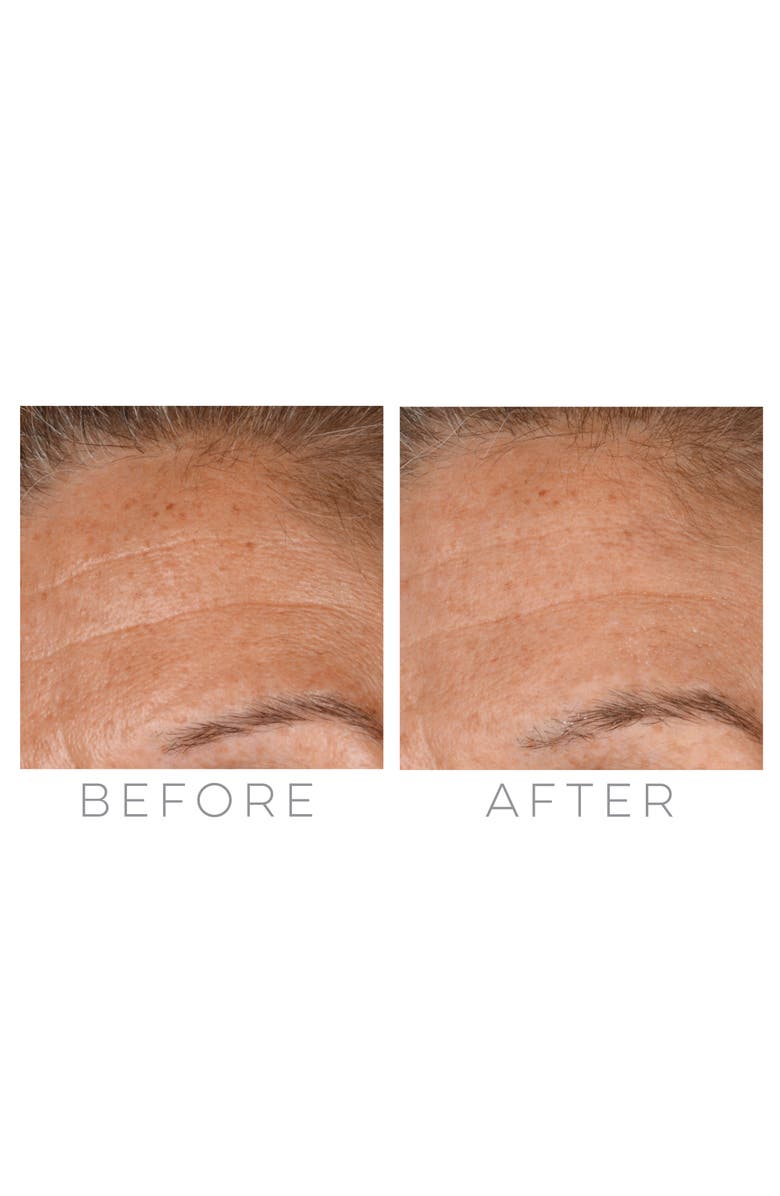 BeautyBio GloPRO<sup>®</sup> Microneedling Regeneration Tool with FACE & BODY MicroTip<sup>™</sup> Attachments, Alternate, color, 