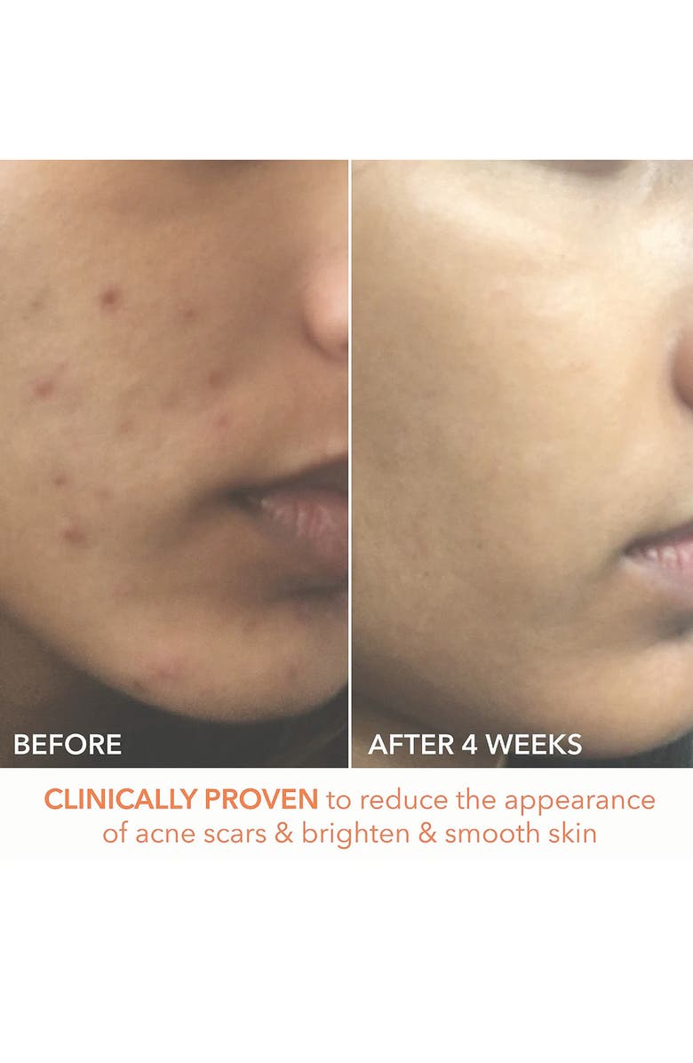 Dr. Dennis Gross Skincare Alpha Beta<sup>®</sup> Extra Strength Daily Peel - 5 Applications, Alternate, color, 