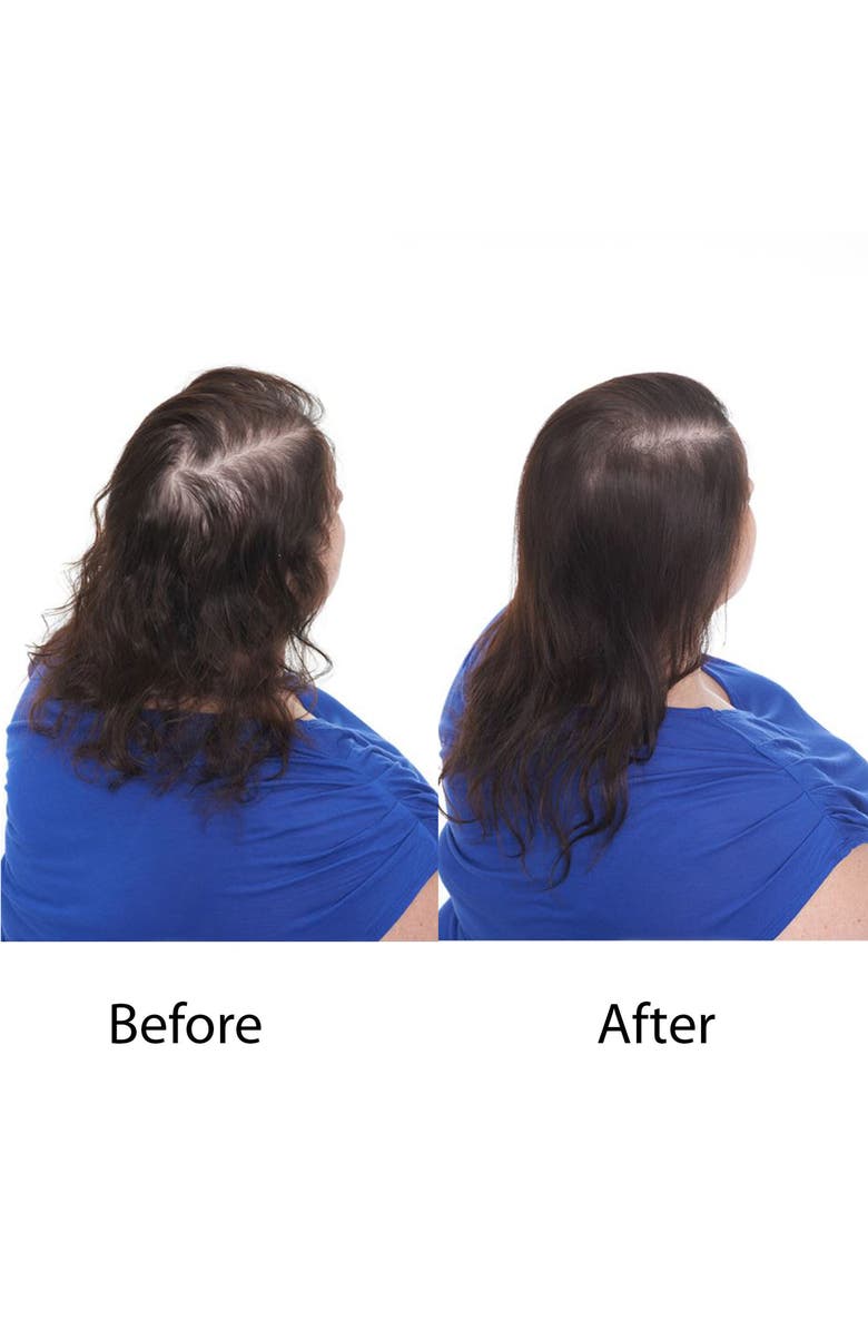 Keranique Deluxe Regrowth Treatment & Deep Hydration Set, Alternate, color,