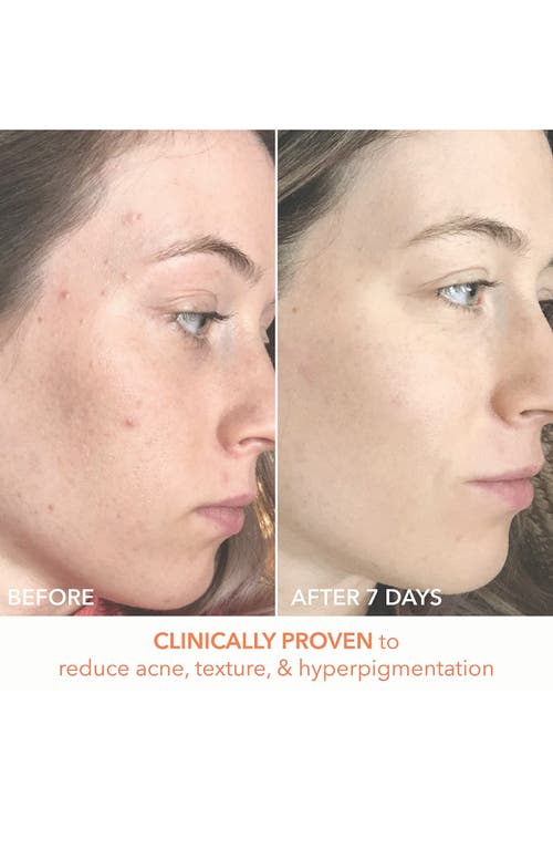 Dr Dennis Gross Skincare Dr. Dennis Gross Skincare Alpha Beta® Peel Original Formula In Transparent