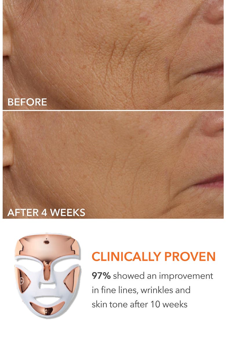 DRx SpectraLite™ FaceWare Pro LED Light Therapy Device & Skin Care Set $641 Value, Alternate, color, NO COLOR