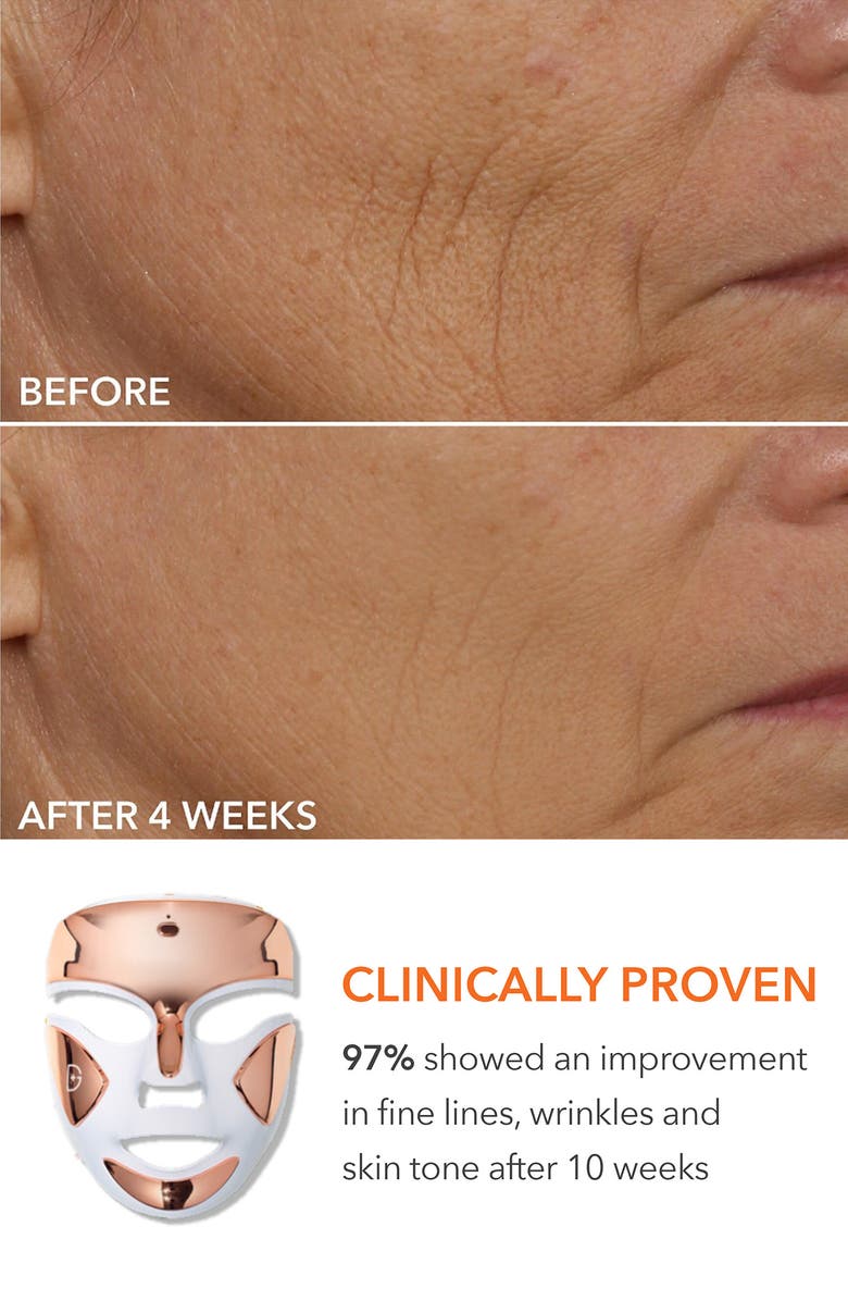 Dr. Dennis Gross Skincare DRx SpectraLite<sup>™</sup> FaceWare Pro LED Light Therapy Device & Skin Care Set $641 Value, Alternate, color,