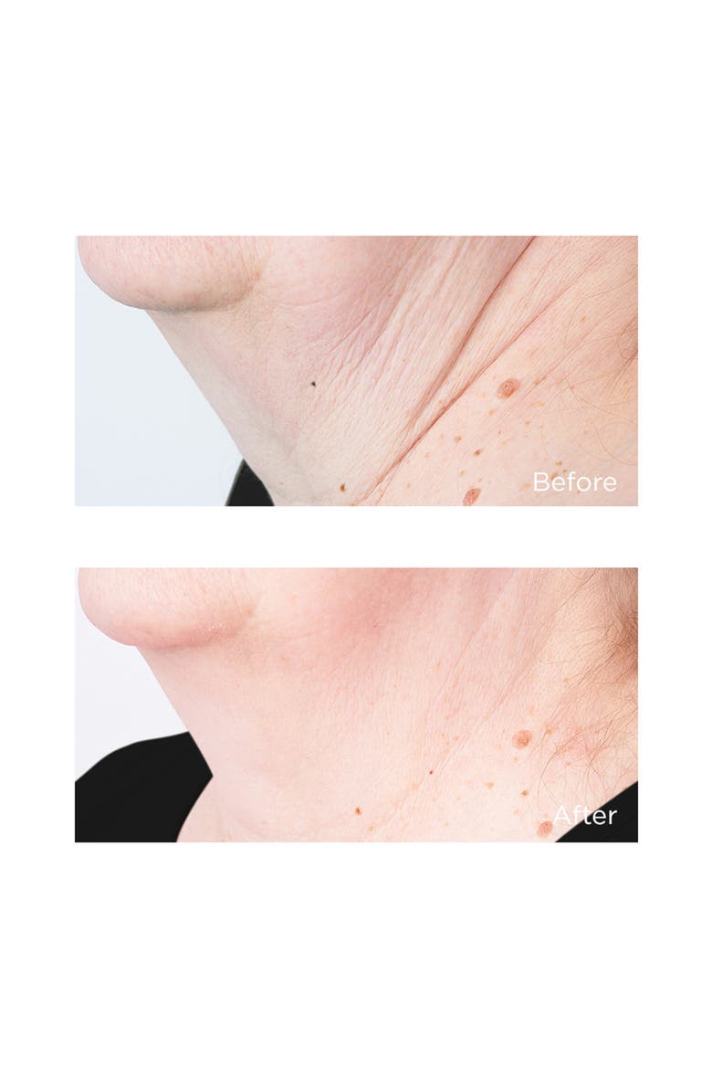 Cold Plasma+ Sub-D Neck Treatment, Alternate, color, NO COLOR