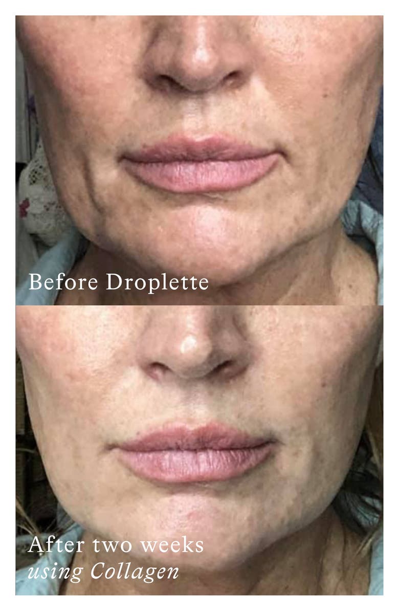 Droplette Microinfusion Device, Alternate, color, 