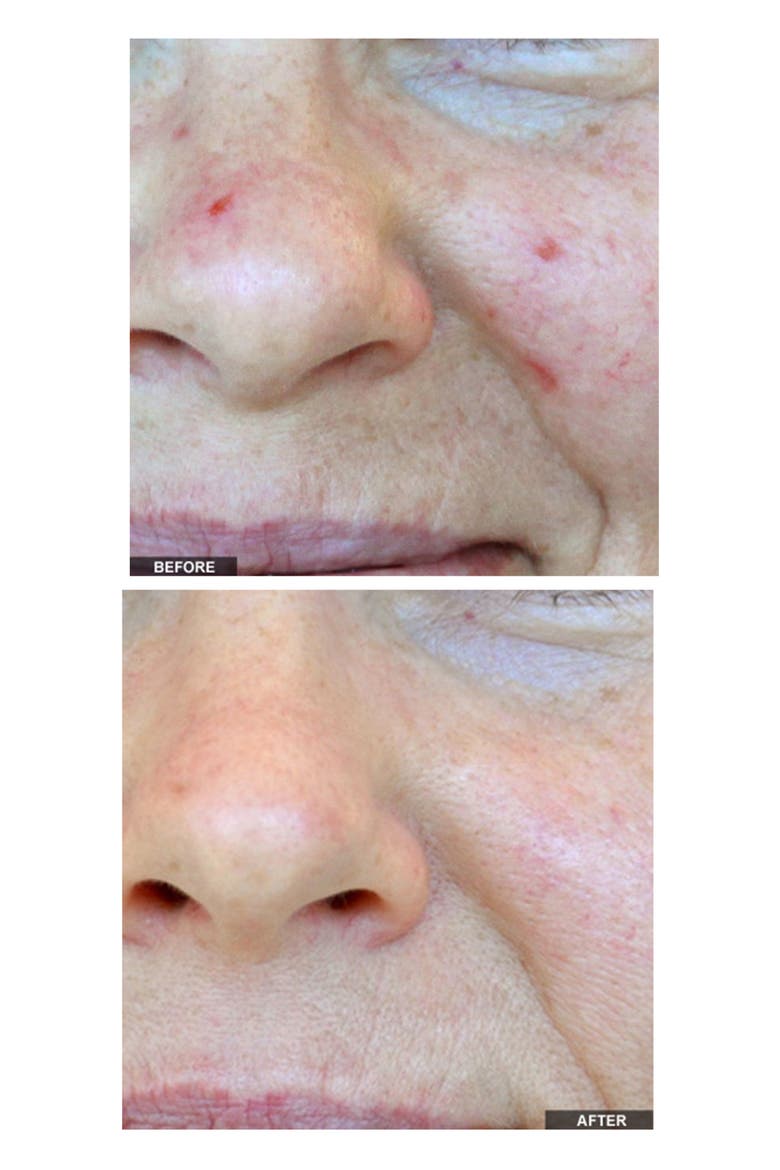 Positively Clear Acne Clearing Blue Light Device, Alternate, color, NO COLOR
