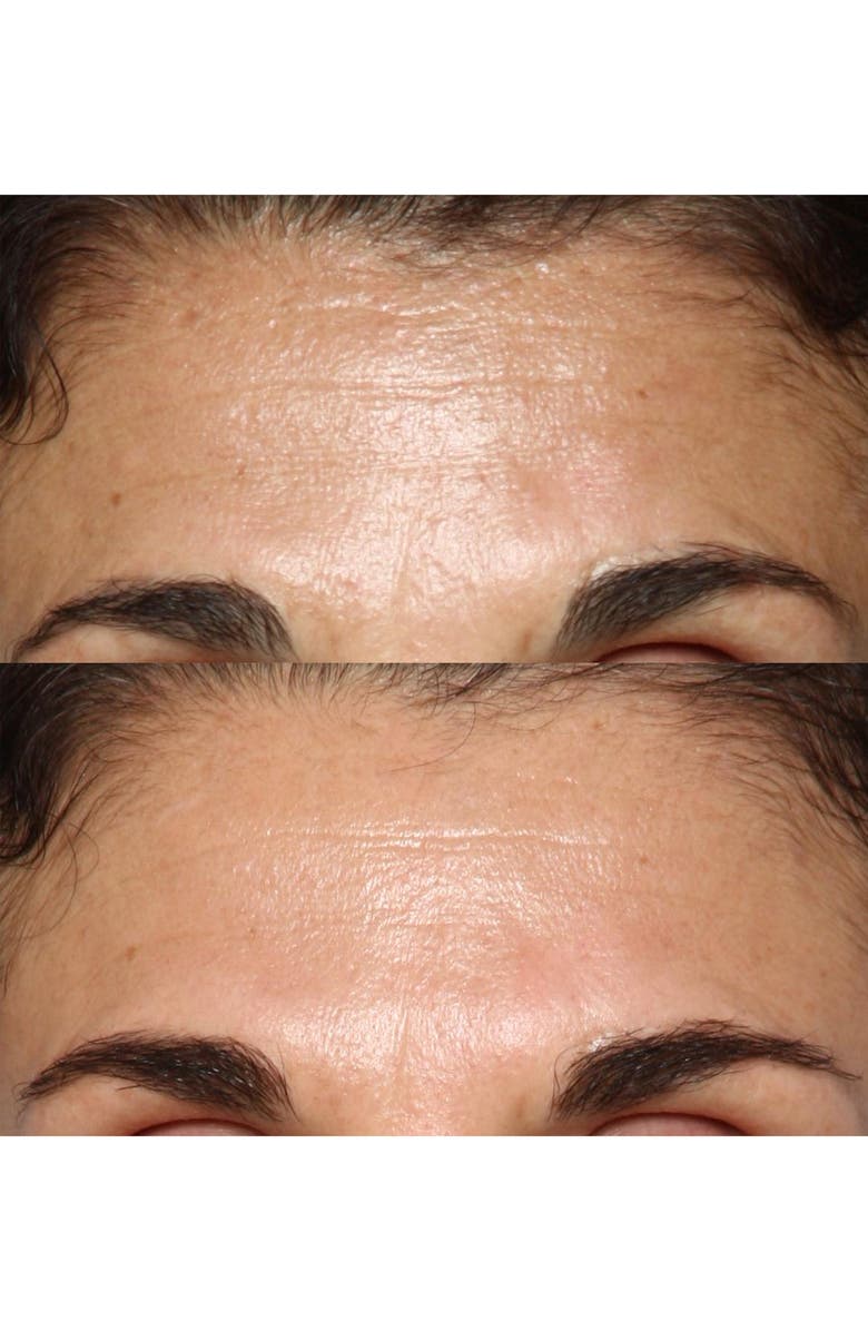 Silk'n FaceFX<sup>™</sup> Anti-Aging Device, Alternate, color, 