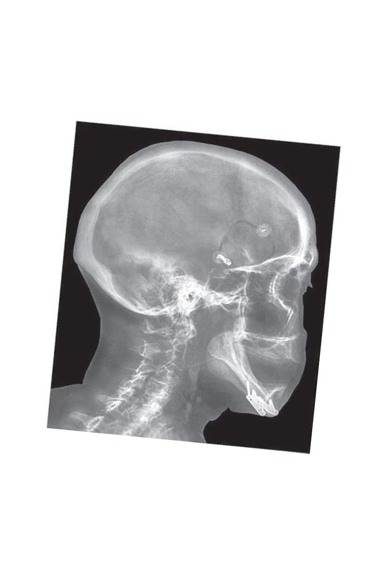Broken Bones X-Rays, Alternate, color, Multicolor