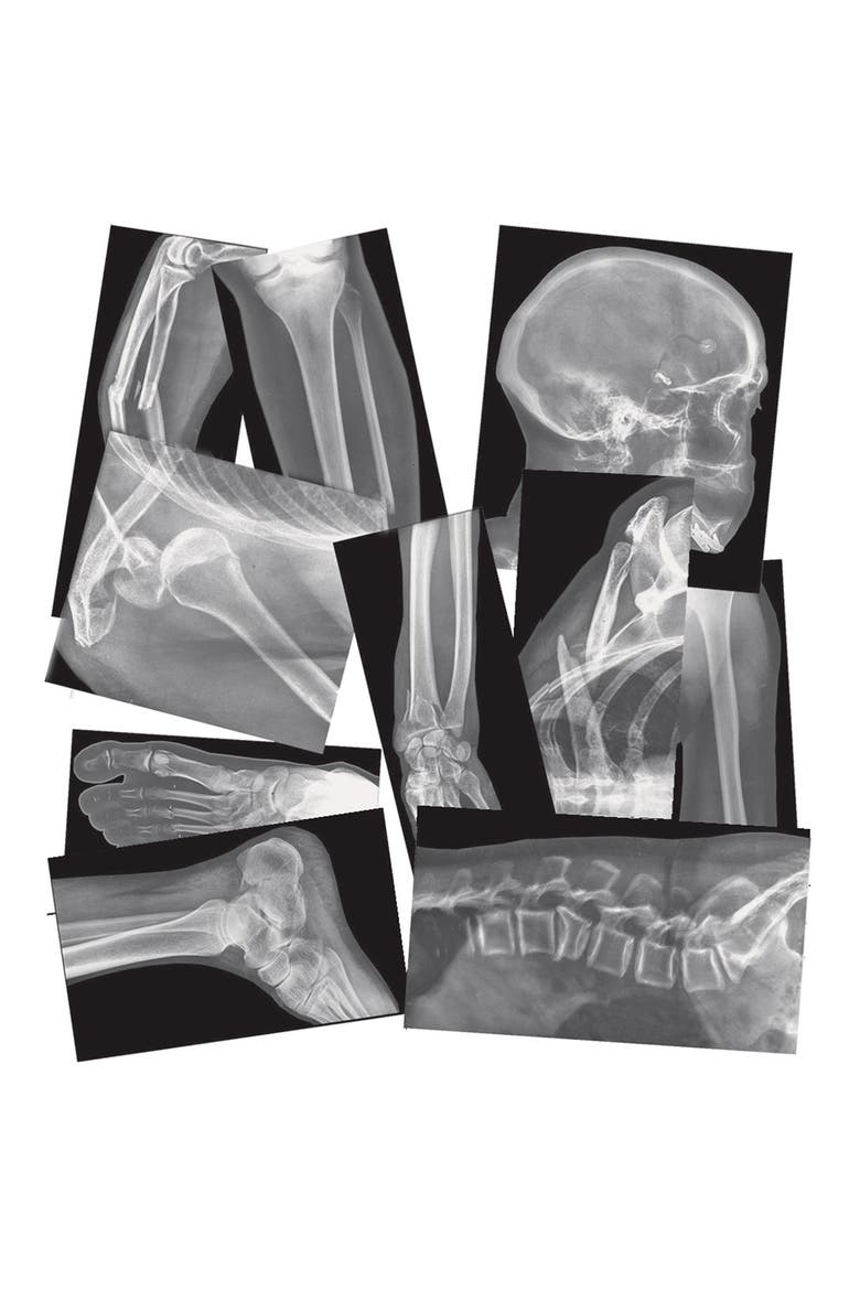 Broken Bones X-Rays, Alternate, color, Multicolor