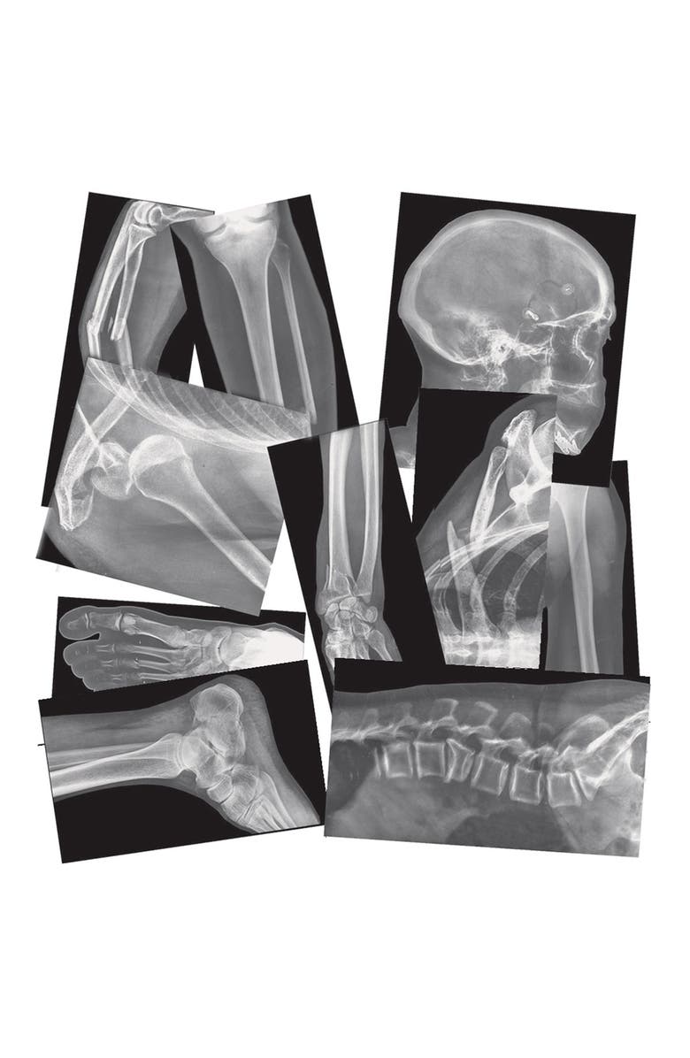 Roylco Broken Bones X-Rays, Alternate, color, Multicolor